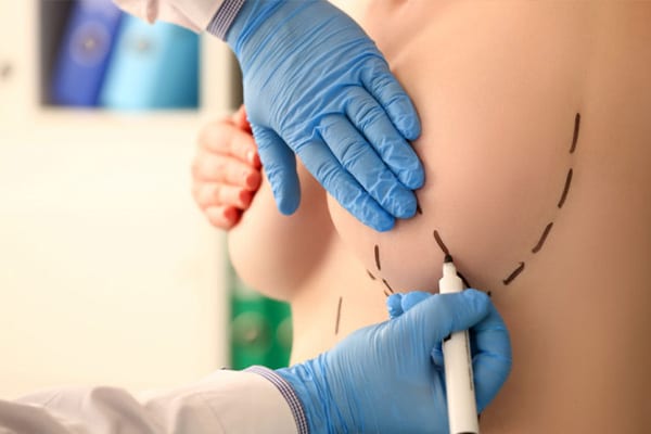 Comment se présente le résultat d’un lipofilling mammaire réussi ?